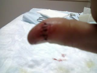 all stitched up